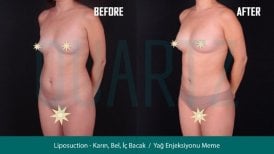 Before and after breast augmentation with fat transfer results at Quartz Hospital