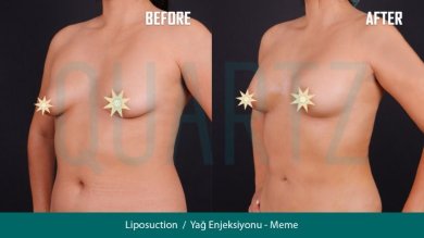 Before and after breast augmentation with fat transfer results at Quartz Hospital
