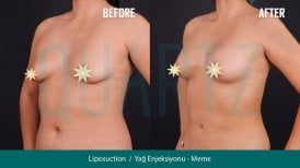 Before and after breast augmentation with fat transfer results at Quartz Hospital