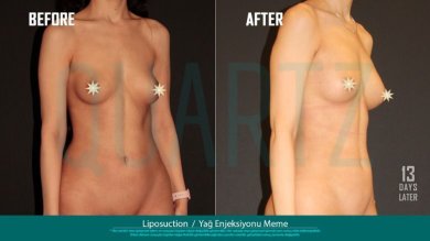 Before and after breast augmentation with fat transfer results at Quartz Hospital