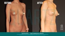 Before and after breast augmentation with fat transfer results at Quartz Hospital