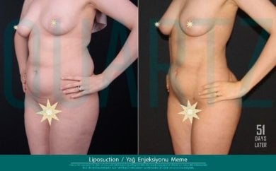 Before and after breast augmentation with fat transfer at Quartz Hospital, visible contour result