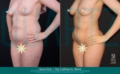Before and after breast augmentation with fat transfer at Quartz Hospital, visible contour result