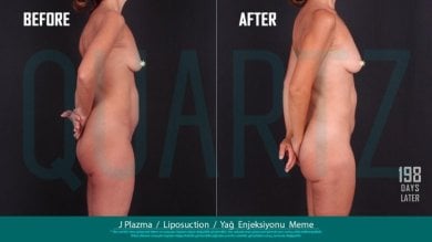 Before and after breast augmentation with fat transfer results at Quartz Hospital, 198 days later