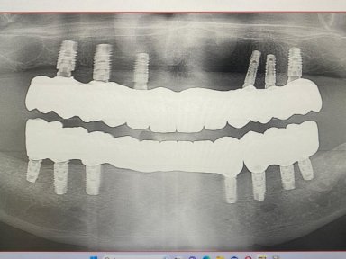 before-after photo dental-implant