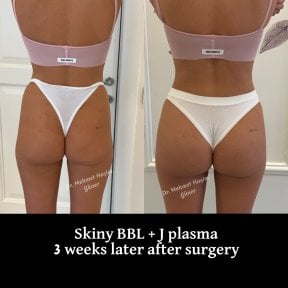 نتائج قبل وبعد عملية Skinny BBL مع J plasma في عيادة Op. Dr. Mehmet Haşim Güner بعد 3 أسابيع