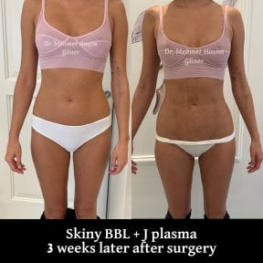 قبل وبعد عملية Skinny BBL مع J plasma في عيادة Op. Dr. Mehmet Haşim Güner، نتيجة بعد 3 أسابيع