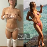 قبل وبعد عملية Vaser BBL مع J Plasma في عيادة Op. Dr. Mehmet Haşim Güner، نتيجة شهر