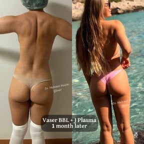 قبل وبعد Vaser BBL مع J Plasma في عيادة Op. Dr. Mehmet Haşim Güner، نتيجة شهر