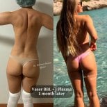 قبل وبعد Vaser BBL مع J Plasma في عيادة Op. Dr. Mehmet Haşim Güner، نتيجة شهر