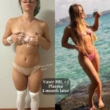 قبل وبعد عملية Vaser BBL مع J Plasma في عيادة Op. Dr. Mehmet Haşim Güner، نتيجة شهر