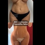 نتائج قبل وبعد شد المؤخرة البرازيلية مع J-Plasma في عيادة د. محمد هاشم غونر بعد شهرين