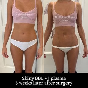 قبل وبعد عملية Skinny BBL مع J Plasma في عيادة Op. Dr. Mehmet Haşim Güner، نتيجة بعد 3 أسابيع