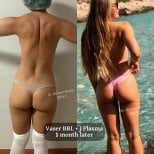 قبل وبعد عملية Vaser BBL مع J Plasma في عيادة Op. Dr. Mehmet Haşim Güner، بعد شهر