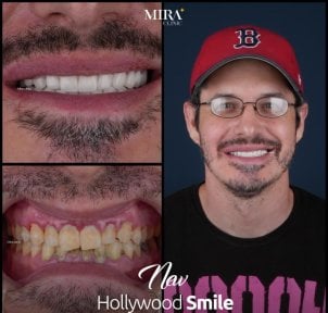 before-after photo dental-crown-installation