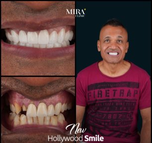 before-after photo dental-crown-installation
