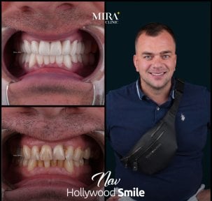 before-after photo dental-crown-installation