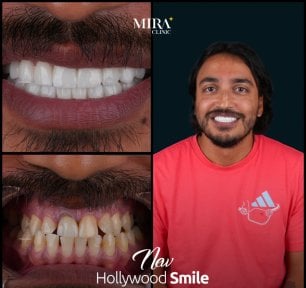 before-after photo dental-crown-installation