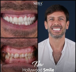 before-after photo dental-crown-installation