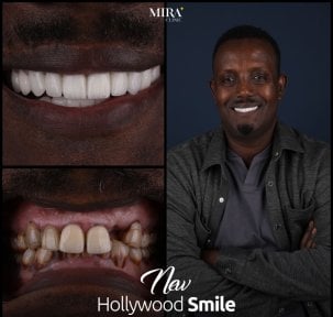 before-after photo dental-crown-installation