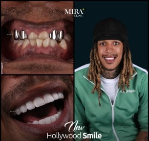 before-after photo dental-crown-installation