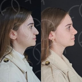Before and after rhinoplasty results at Dr. Safa Manav Clinic, improved nose profile