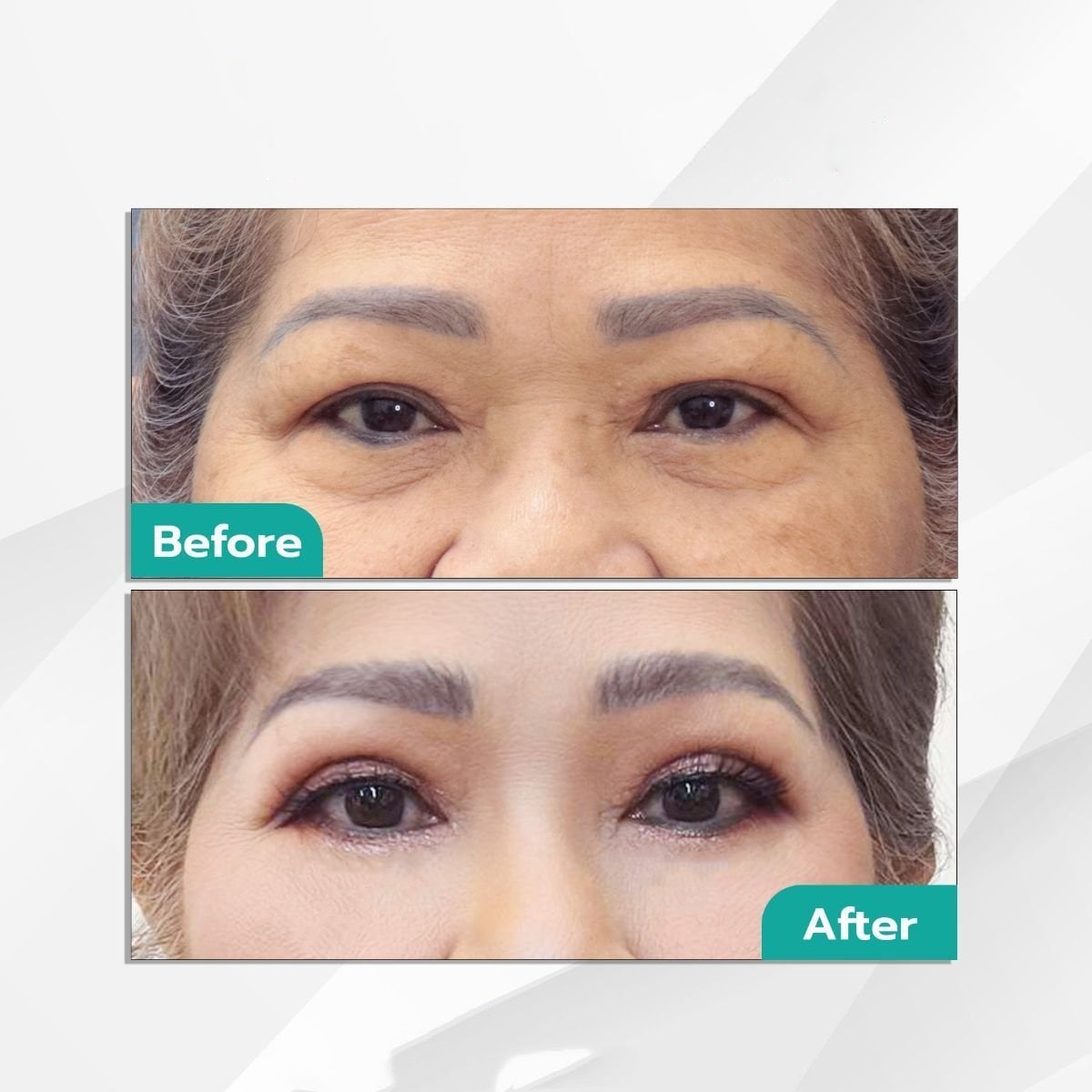 Resultados de blefaroplastia inferior antes y después en Intrarat Hospital, rejuvenecimiento ocular