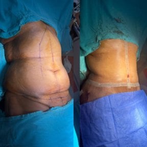 before-after photo liposuction