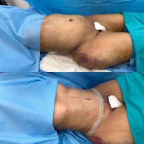 before-after photo liposuction