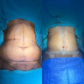 before-after photo liposuction
