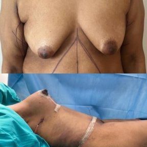 before-after photo breast-augmentation