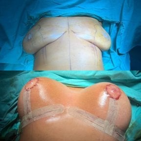 before-after photo breast-augmentation