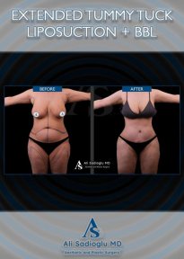 Efekty przed i po: plastyka brzucha, liposukcja, BBL w klinice Dr. Safa Manav