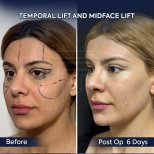 Vorher-nachher-Ergebnis von Temporal- und Midface-Lift in Dr. Safa Manav Klinik, 6 Tage