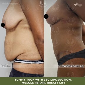 before-after photo mommy-makeover
