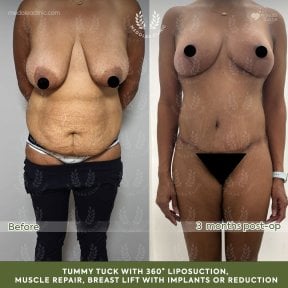 before-after photo mommy-makeover