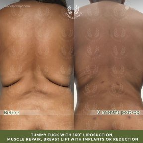 before-after photo mommy-makeover