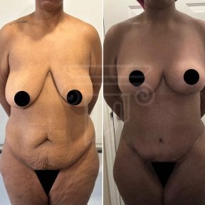 before-after photo mommy-makeover