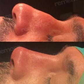 before-after photo rhinoplasty-nose-job