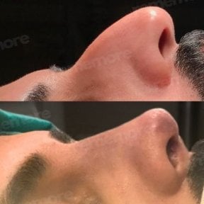 before-after photo rhinoplasty-nose-job