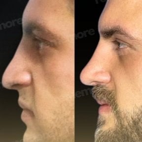 before-after photo rhinoplasty-nose-job