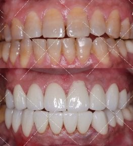 before-after photo smile-makeover