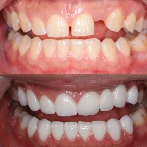 before-after photo smile-makeover