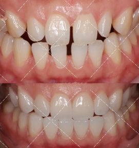 before-after photo smile-makeover