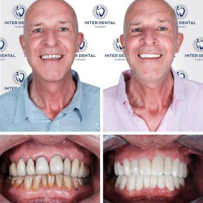 before-after photo dental-crown-installation