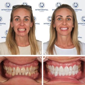 before-after photo dental-crown-installation