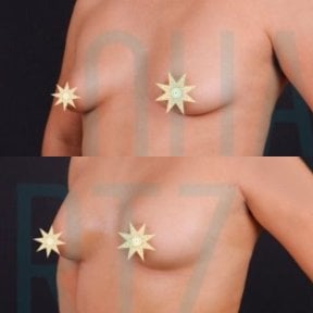before-after photo breast-augmentation-with-fat-transfer