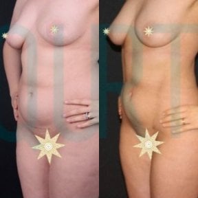 before-after photo breast-augmentation-with-fat-transfer