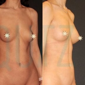 before-after photo breast-augmentation-with-fat-transfer
