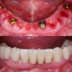 before-after photo dental-implant